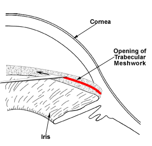 Goniotomy